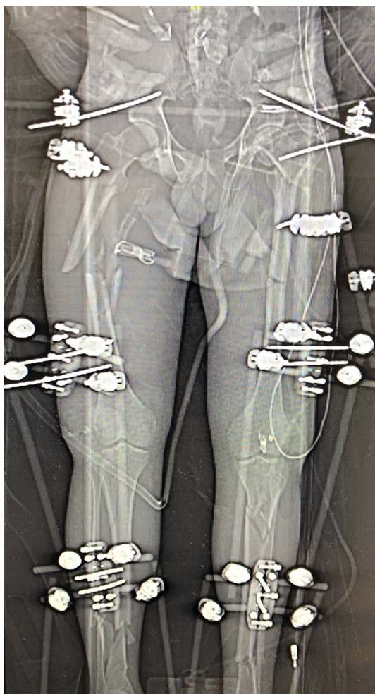 Damage Control Orthopedics — estabilización provisional
