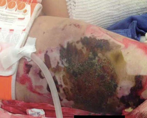 Fractura con quemadura asociada — caso clínico 1